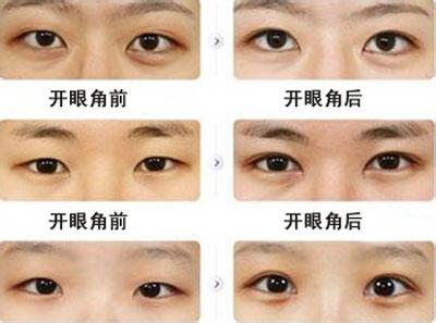 如果是单眼皮的求美者可以做双眼皮手术加开眼角来增大眼睛.